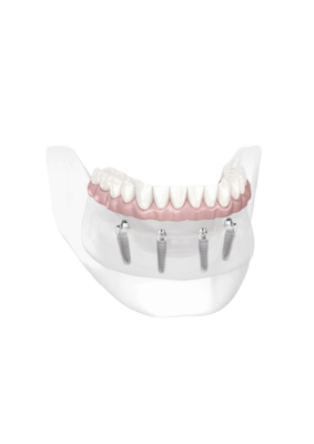 CUSTOMIZED ABUTMENT SYSTEM
